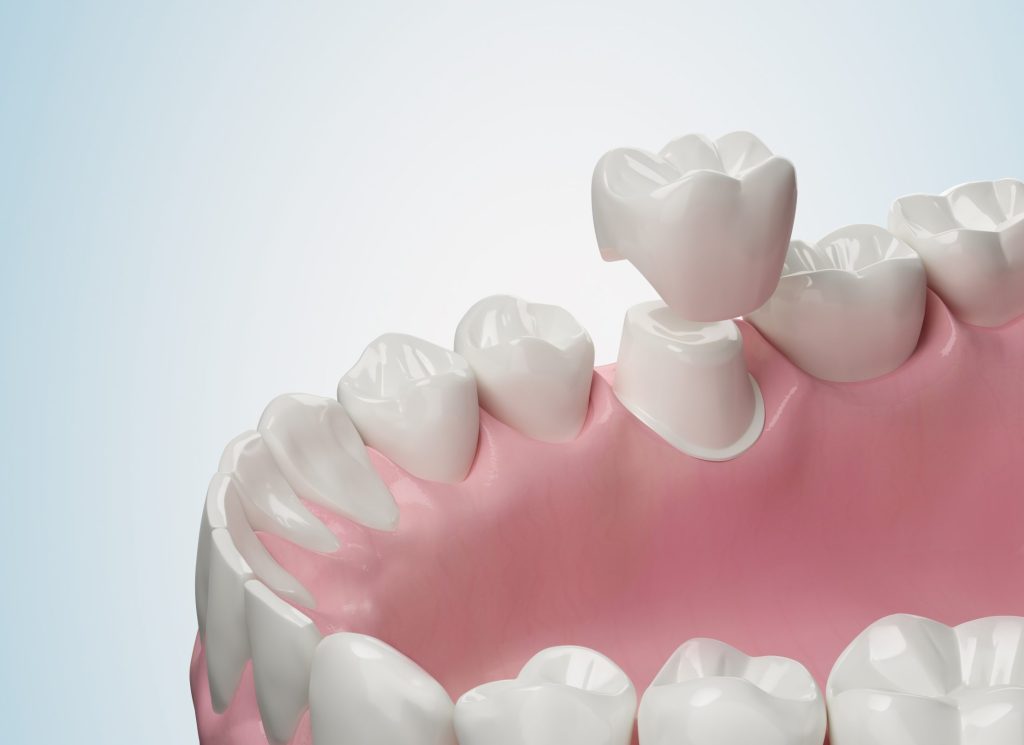 Broken Tooth Before a Big Event? Restore your Smile With CEREC Crowns
